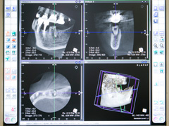 歯科用CT