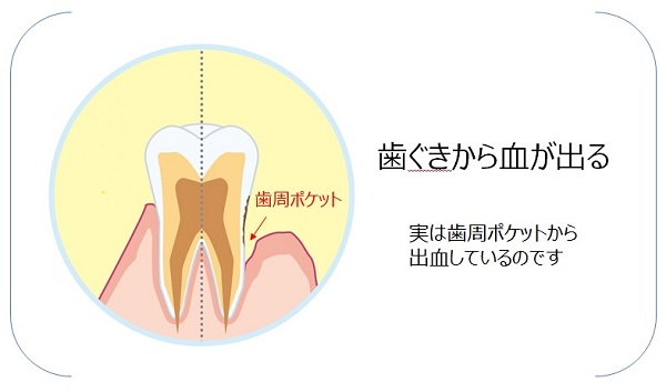 歯ぐきからの血