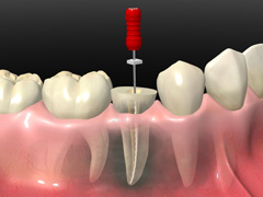 根管治療（歯の根の治療）